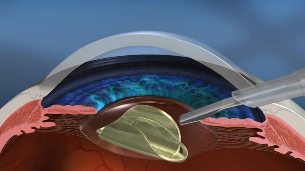 Como é feita a cirurgia de catarata? Veja o pós-operatório!