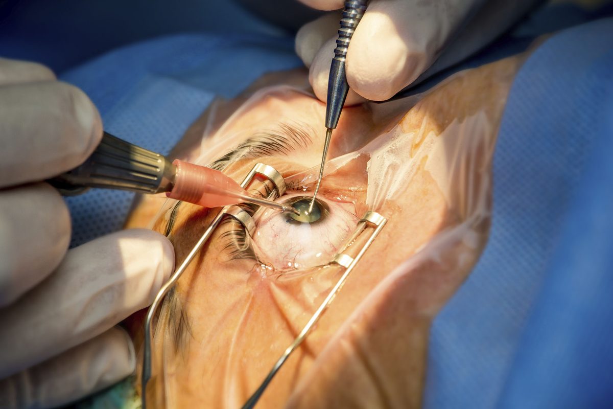 Como é feita a cirurgia de catarata? Veja o pós-operatório!